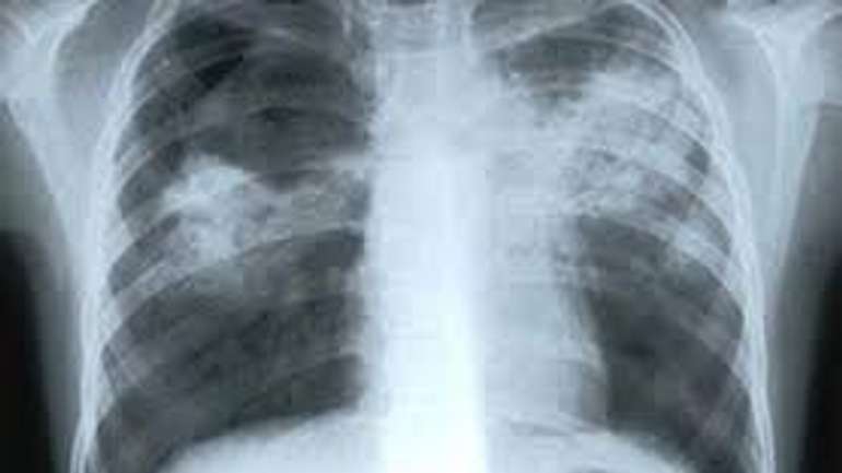​Хворих на туберкульоз "викидають" із тубдиспансерів та змушують платити за безкоштовне лікування