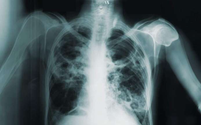 Кашель не головний симптом туберкульозу — науковці