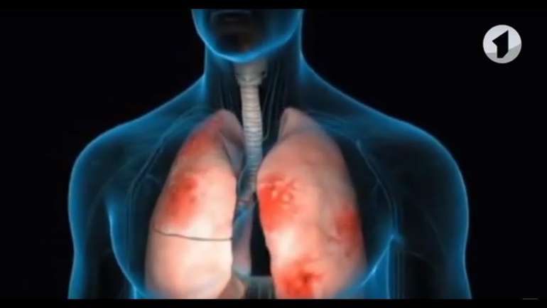 У Кременчуці 76 людей лікують від пневмонії