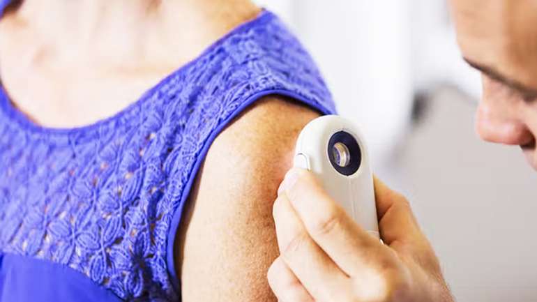 Британські лікарі попереджають: спекотне літо сприяє зростанню раку шкіри