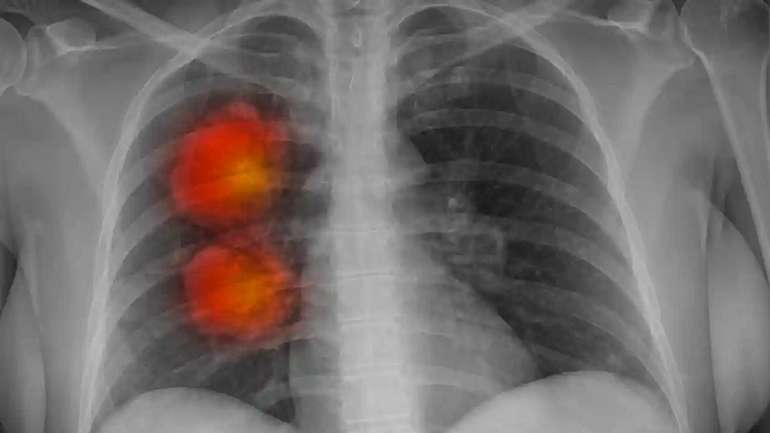 Штучний інтелект навчився ідентифікувати рак на ранніх стадіях